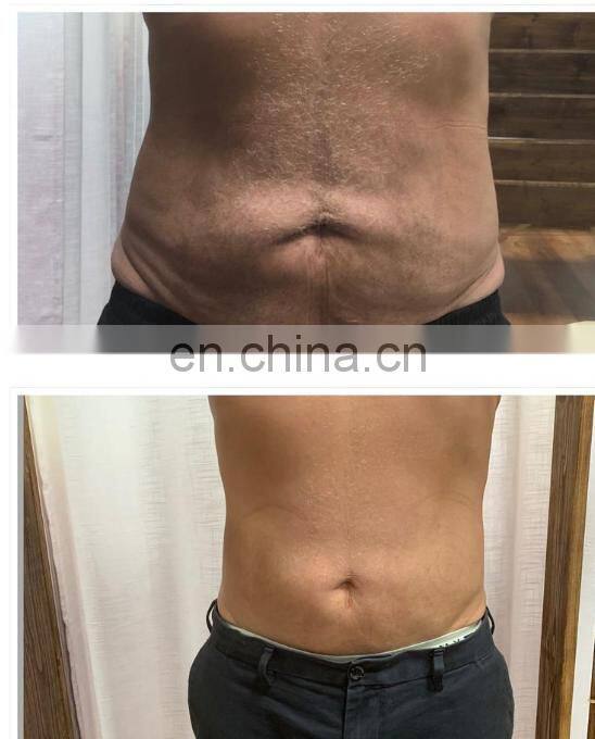 High quality electrical muscle stimulation device electromagnetic tesla hip trainer physiotherapy muscle stimulator