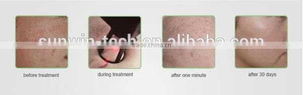 2016 hot sale laser skin renewing , skin rejuvenation, RF fractional CO2 laser dermabrasion