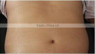 Portable slim freeze machine with cryolipolysi beauty machine
