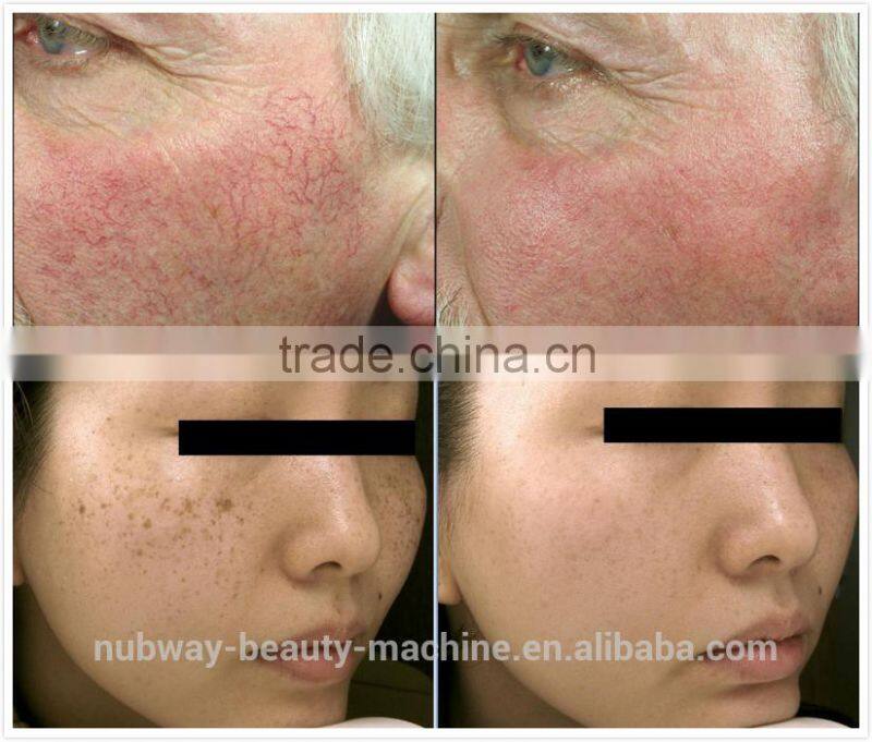 FDA Approved Laser Hair Removal Machine IPL With RF Israel