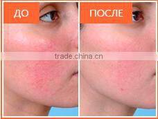 MBT LASER shr ipl Professional Multifunction digital permanent hair removal skin rejuvenation opt machine