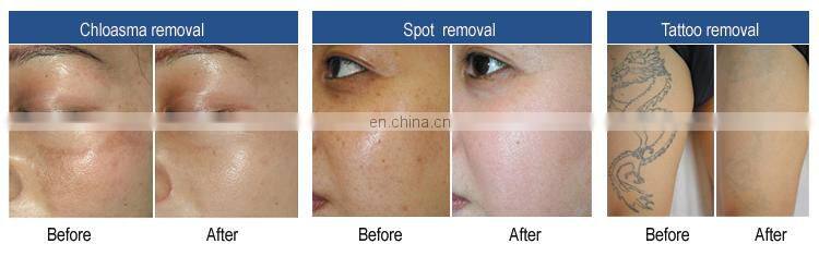 Vertical 1064nm 532nm Q-Switch ND YAG Laser Tattoo Removal Machine Carbon Peel
