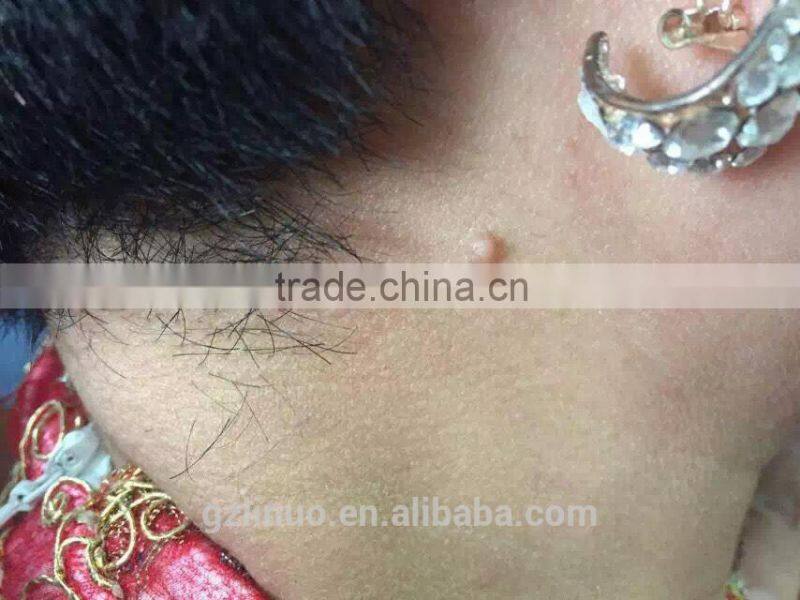 Beauty and health mole removal machine , nevus removal machine