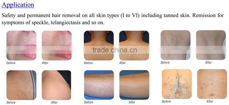 808nm diode laser hair removal machine portable