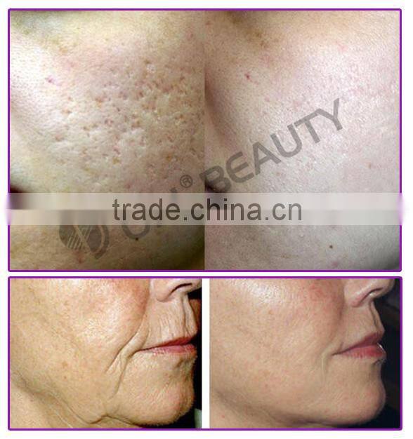 Alibaba express vaginal tightening co2 fraction laser OD-V8