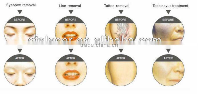 high power medical CE approval Grand q switched nd yag laser tattoo removal machine