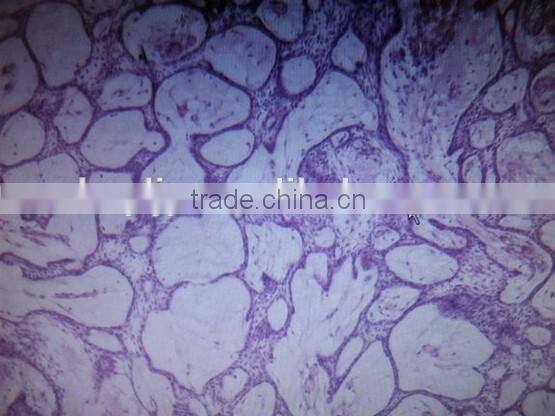 adamantoblastoma oral pathology prepared slides/teaching oral pathology slides/medical oral pathology slides