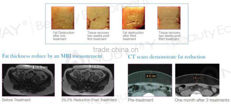 Hot sale! high frequency focused ultrasound roller lipo cavitation machine for full body slim