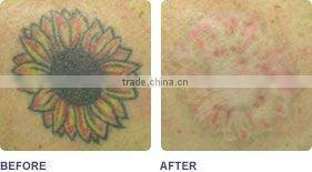 mobile Nd YAG Laser for Tattoo Removal