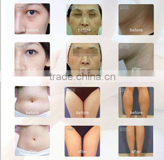 2016 new advanced at home face lift machine