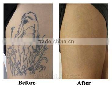 Company Looking for Distributors of Best Product for Pigment Removal Tattoo Removal CE Certified 1064 nm 532nm Nd YAG Laser