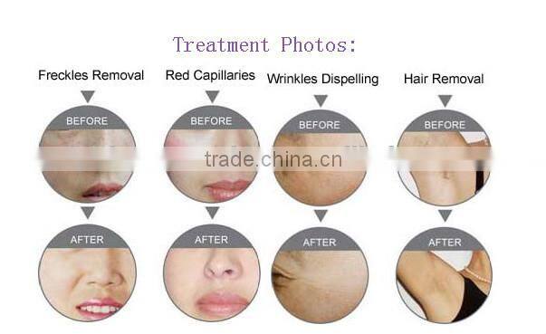 Mini IPL Skin Rejuvenation Machine/ Best Permanent Hair Removal IPL Beauty Device