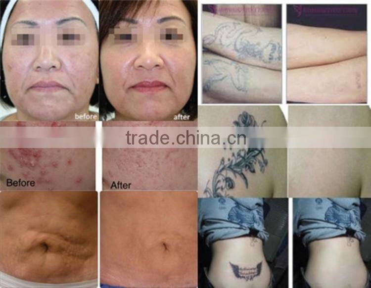 Tattoo Machine Laser Tattoo Removal Machine