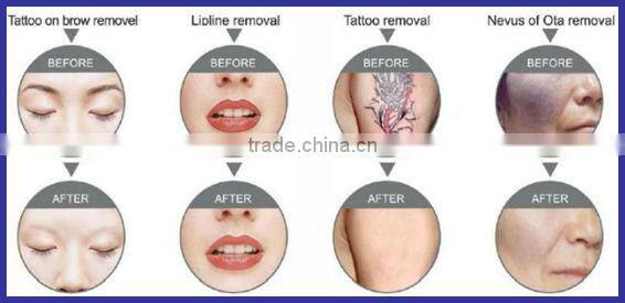 2015 trending hot IPL Elight hair removal /q switched nd yag laser tattoo removal