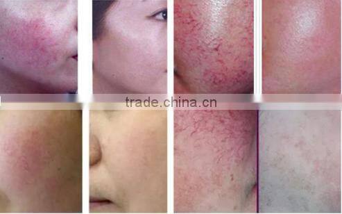 vascular vein spider vein removal rf / high power spider vein removal machine / 30mhz spider vein removal device