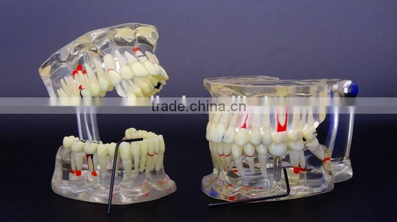 Dental adult pathological dentition model DEA-48 teeth model teaching demonstration
