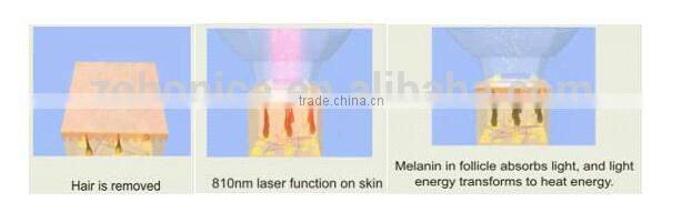 Y9D-Ydel CE approved micro channel 755nm 808nm 1064nm diode laser depilator