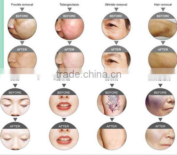 2016 HIgh quality SHR fast ipl hair removal / yag laser tattoo removal machine