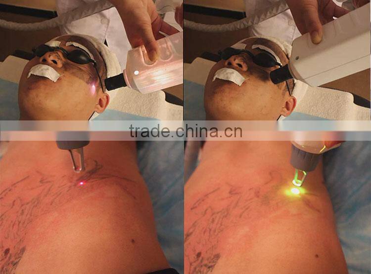 2015 new arrival Q-switched nd yag laser tattoo removal beauty parlor instrument