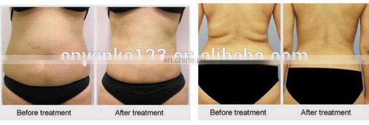 Painless Ultrasonic RF Skin Rejuvenation/ Fat Burning Salon Beauty Machine