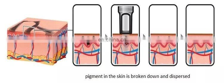 Professional 2 in 1 808 Diode Laser Hair Removal Picosecond Laser Tattoo Removal Machine