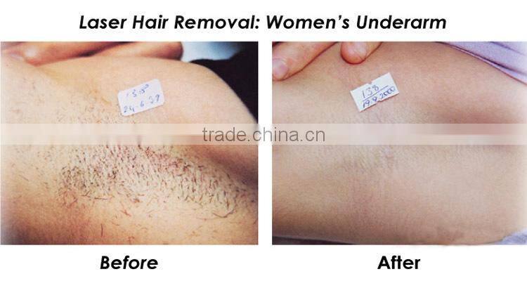 vertical lightsheer 808 nm diode laser hair removal machine price