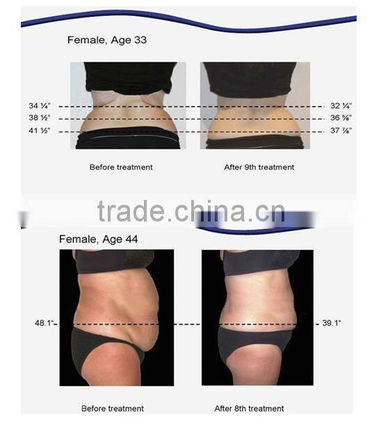 New non-surgical lipo laser fat removal no invasive lipo laser slimming machine SL-3