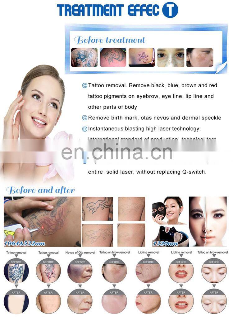 New generation pigment removal 1320nm 1064nm laser q switch nd yag laser tattoo removal machine price
