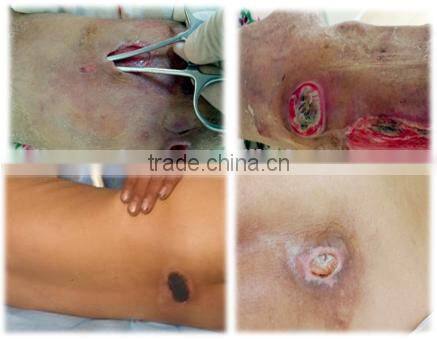 Alternating Pressure Mattress Systems Hospital anti decubitus mattress hospital medical bed air mattress