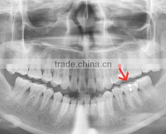 Konida dental hot sex 14*17 agfa medical filmagfa holder fuji dry film