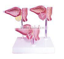 Best price good quality Prostatism model