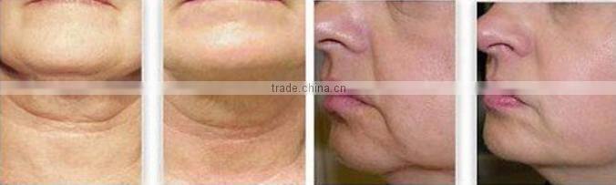 AYJ-T29C(CE)Multi-Function Beauty Equipment Type RF machine RF micro needle