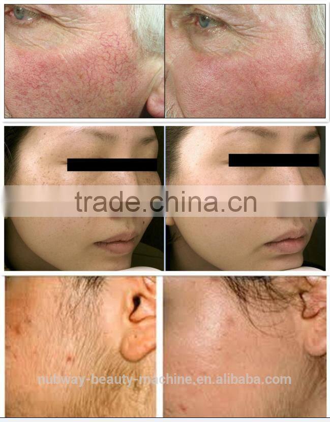 Best Choice For Home Use Portable Nubway I7 IPL Machine With Sapphire Crystal