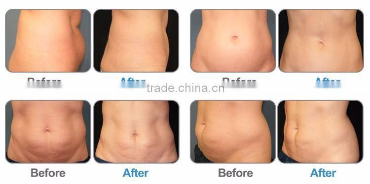 New 2 in 1 combination cryolipolyse ultrasonic cavitation machine fat removal equipment