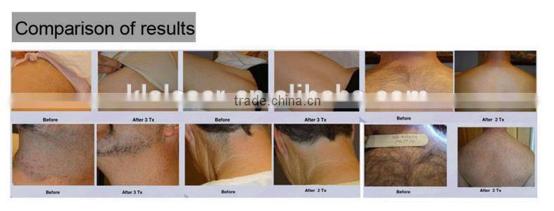 home use potable 808nm diode laser epilator home laser hair removal