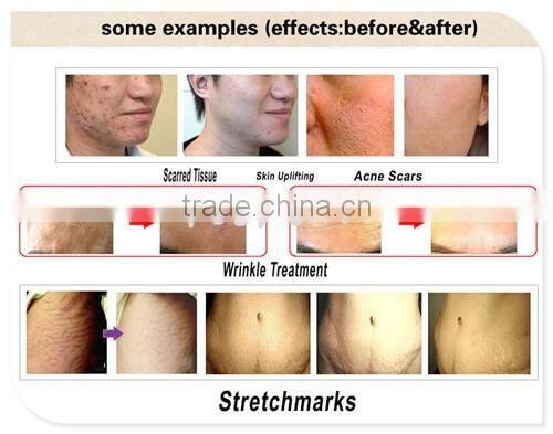 Derma Roller Micro Needle Therapy Skin Care Recovery Luxury Micro Needle Therapy Derma Roller Titanium Needles Anti-Ageing