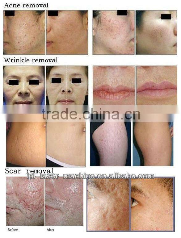 fractional co2 laser acne scar removal