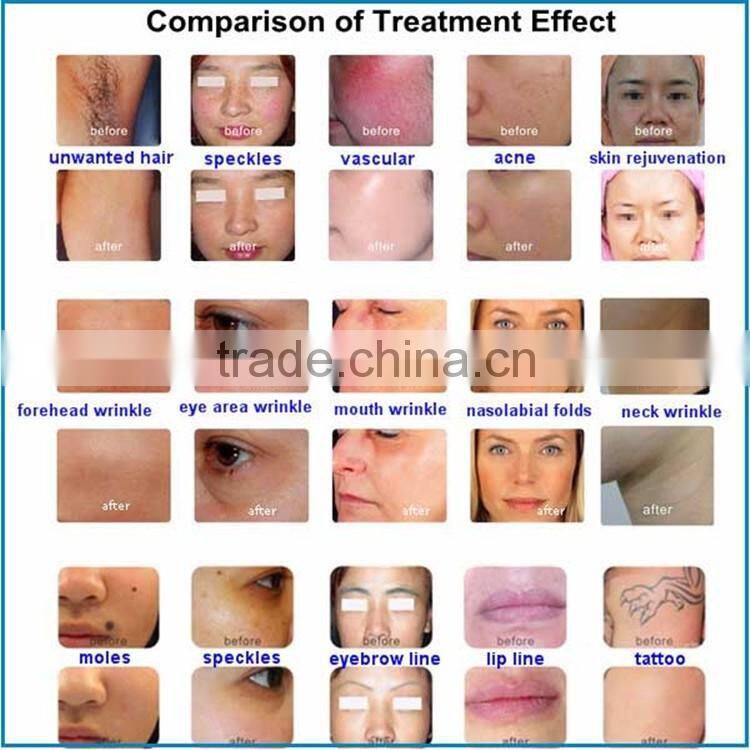 2016 new style e-light ipl rf nd yag laser multifunction machine / permanent hair removal laser machine