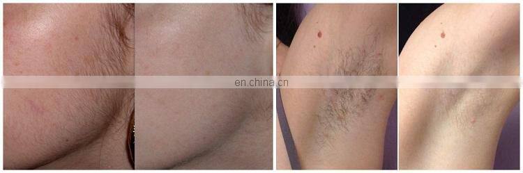 LFS-K8 3 wavelength painless 808 diode laser hair removal/808nm diode laser