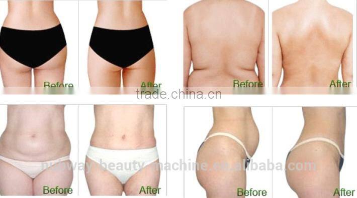 Safe Effective Convenient For Home Use Portable Cryolipolysis Fat Freezing Liposuction