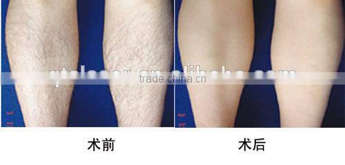 dual wavelength 755nm alexandrite laser removal hair ND YGA alexandrite lasers