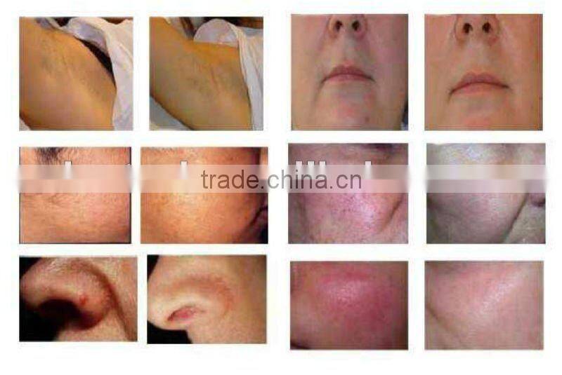 Multi function E-light&RF skin care equipment