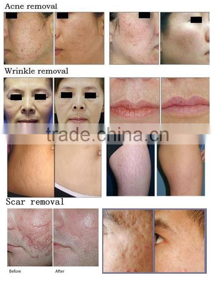 30W RF Mental Tube CO2 Laser Fractional Acne Scar Removal Machine