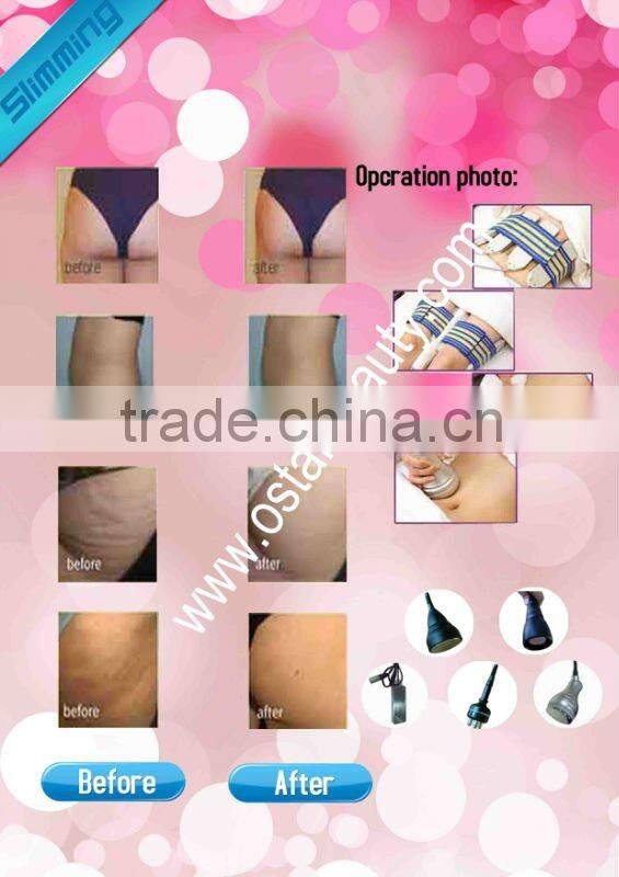 Factory wholesale body vacuum suction machine OB-SRN 05C