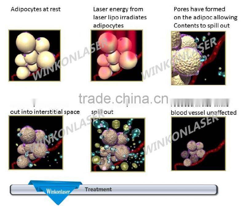 China Factory supply fat removal machine best selling products in america
