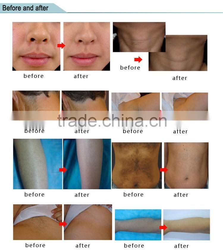 Medical best diode laser 810 nm portable for hair removal diodo laser