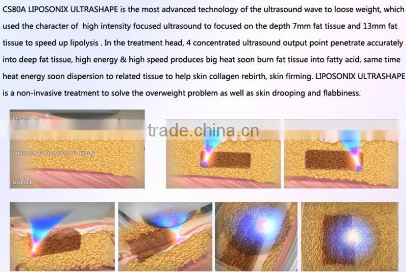 liposonix hifu/ultrasonic wrinkle removal/hifu wrinkle removal