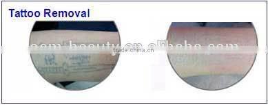 best selling products yag q-switched medical tattoo remove machine with CE certificate D003