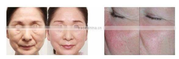 fractional RF beauty equipment for skin lifting wrinkle removal