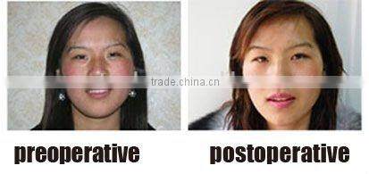 Be in great demand product , laser equipment co2 fractional